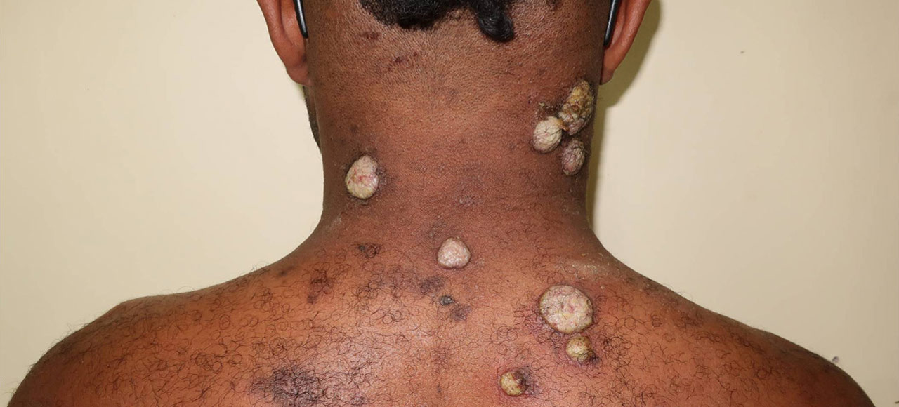 A picture of yaws papillomas on a child living in a yaws endemic village in Papua New Guinea. These papillomas are often an early presentation of yaws and are teeming with bacteria. Credit: World Health Organization
