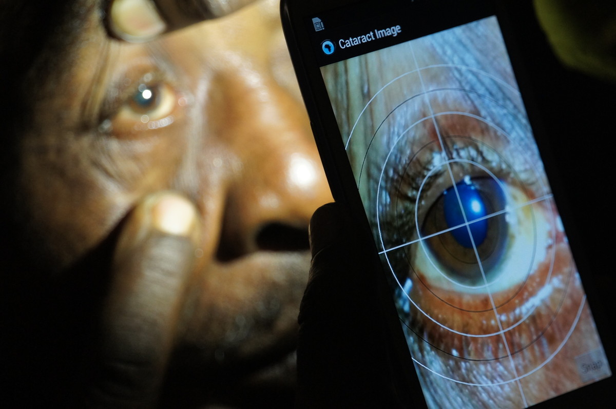 Caption: Cataract diagnosis via Peek technology in Kenya. Credit: Andrew Bastawrous