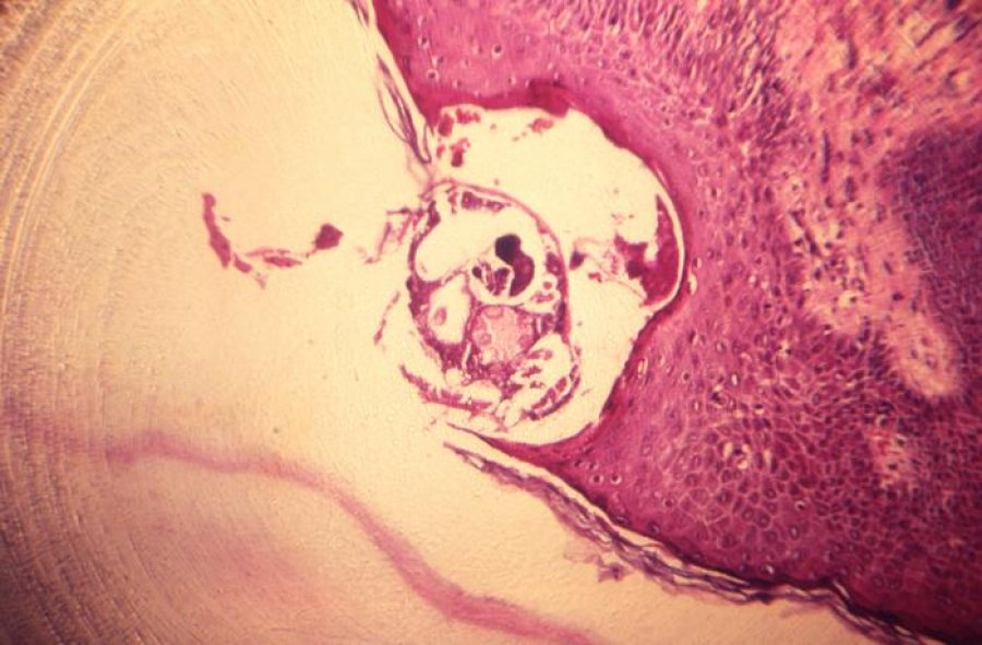 Caption: Photomicrograph of scabies burrowed into skin tissue Credit CDC Public Health Image Library